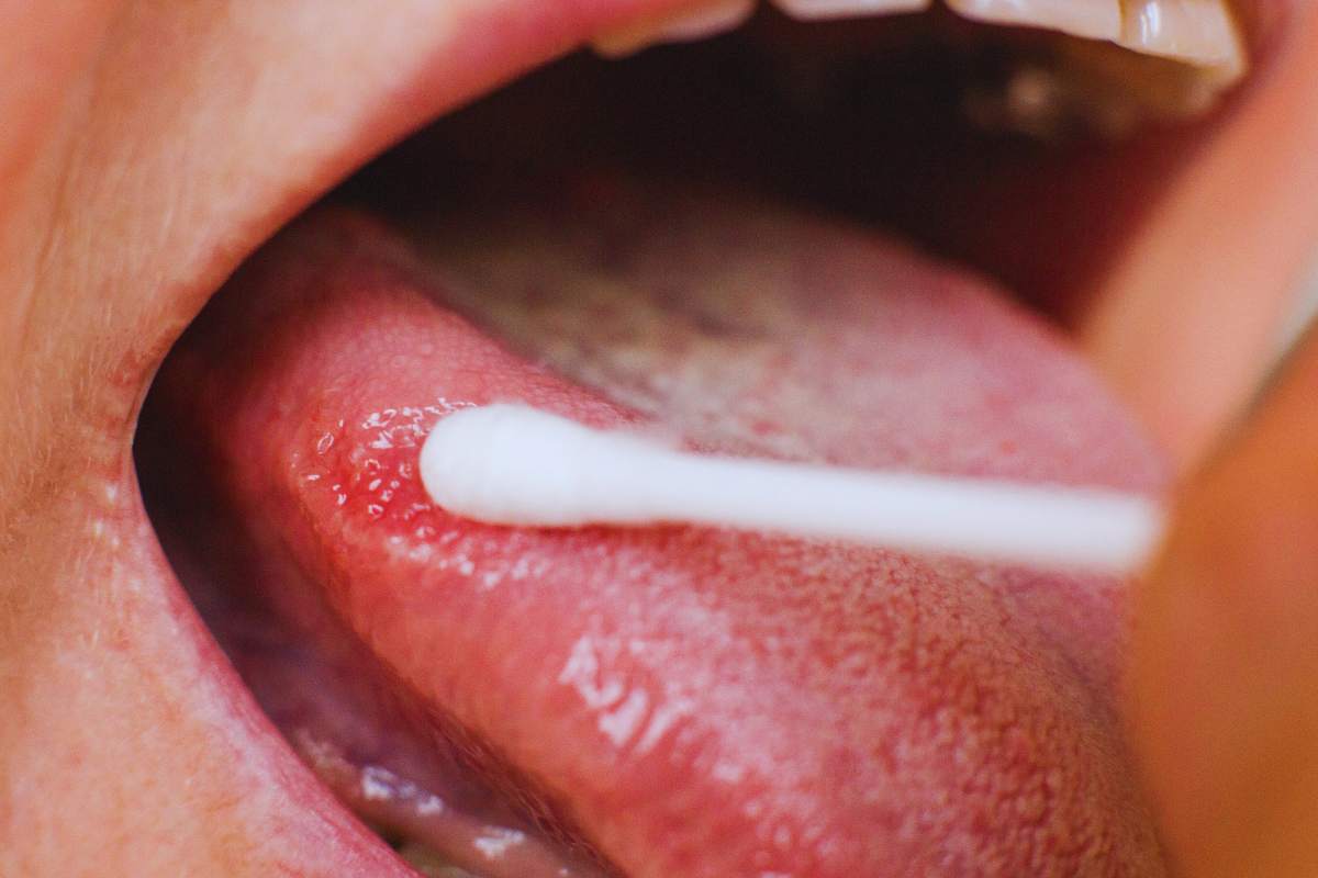 Dolore alla lingua, cosa può essere